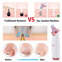 Derma suction Blackhead Remover Vacuum Acne Cleaner Black Spots Removal